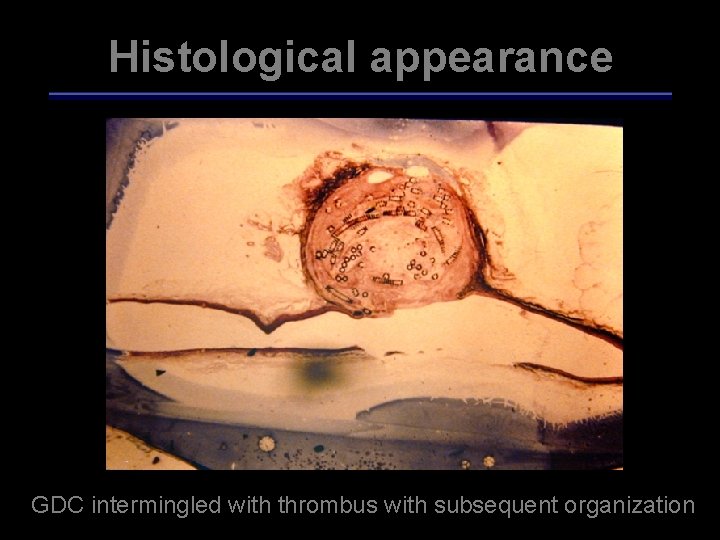 Histological appearance GDC intermingled with thrombus with subsequent organization 
