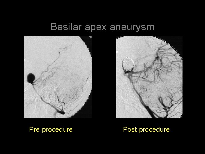 Basilar apex aneurysm Pre-procedure Post-procedure 