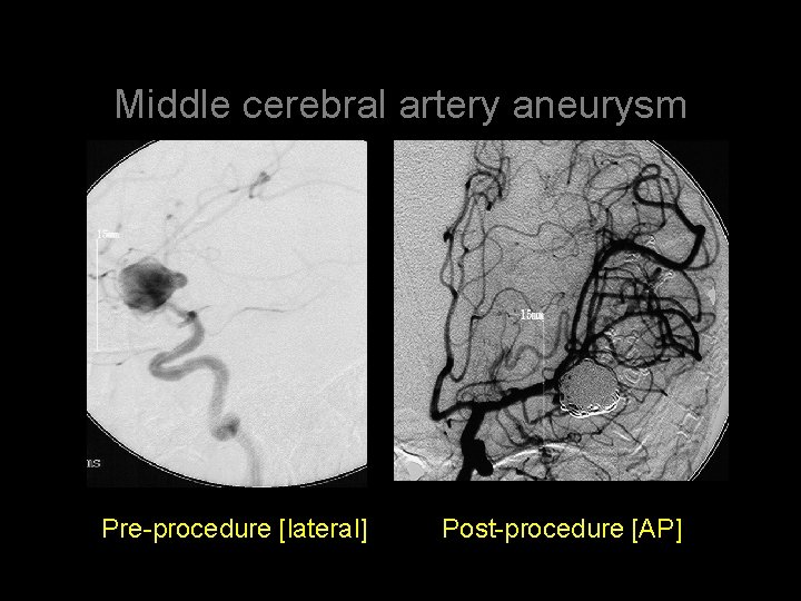 Middle cerebral artery aneurysm Pre-procedure [lateral] Post-procedure [AP] 
