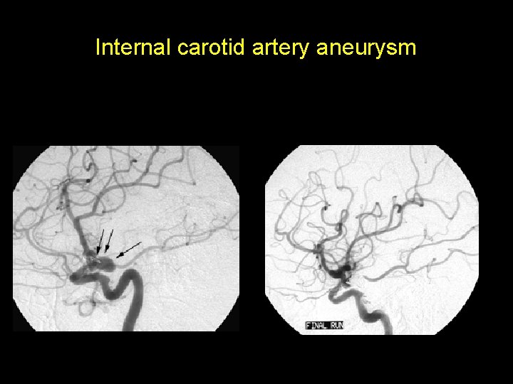 Internal carotid artery aneurysm A. Before Coil B. After Coil Treatment 