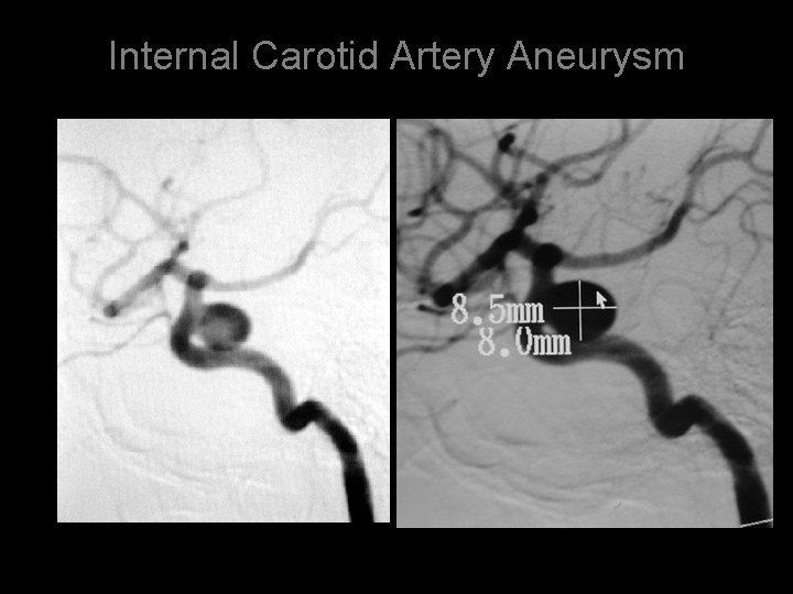 Internal Carotid Artery Aneurysm 