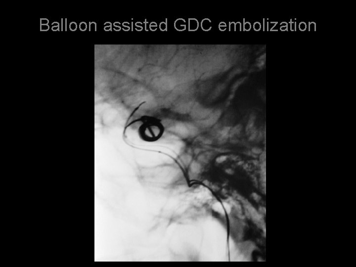 Balloon assisted GDC embolization 