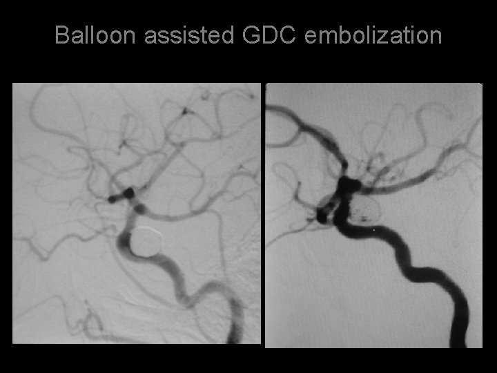 Balloon assisted GDC embolization 