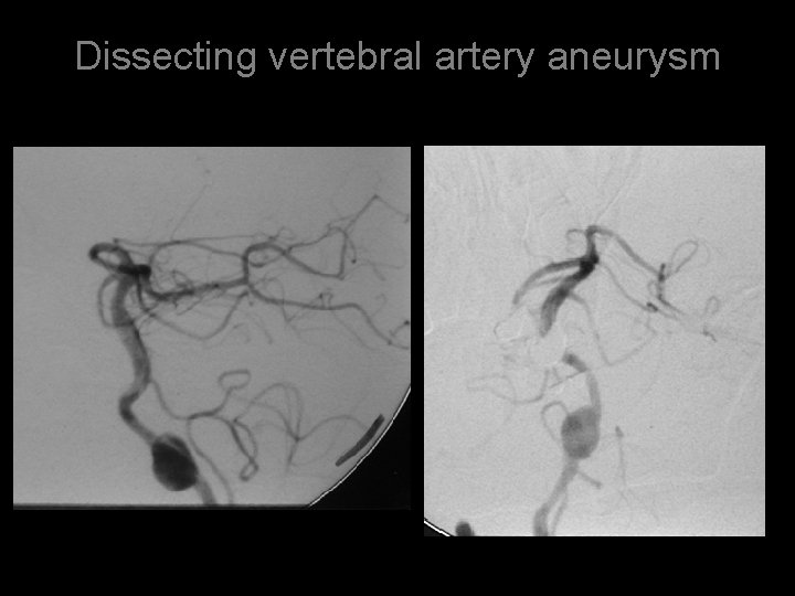 Dissecting vertebral artery aneurysm 