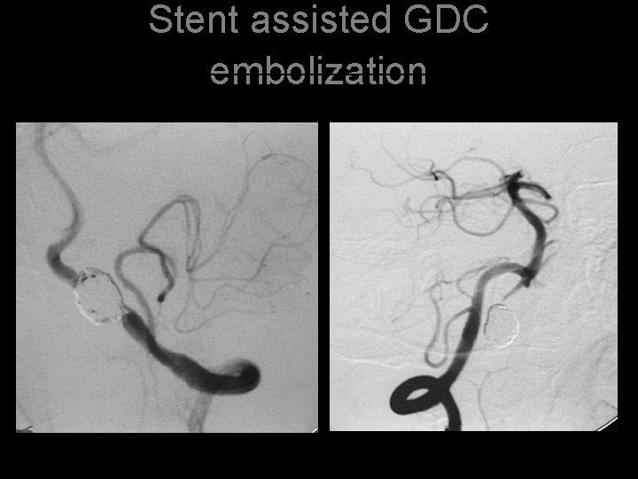 Stent assisted GDC embolization 