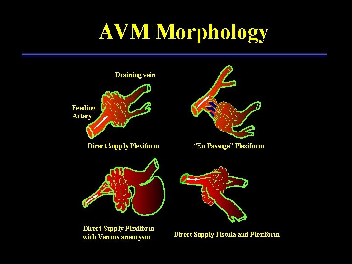 AVM Morphology Draining vein Feeding Artery Direct Supply Plexiform with Venous aneurysm “En Passage”