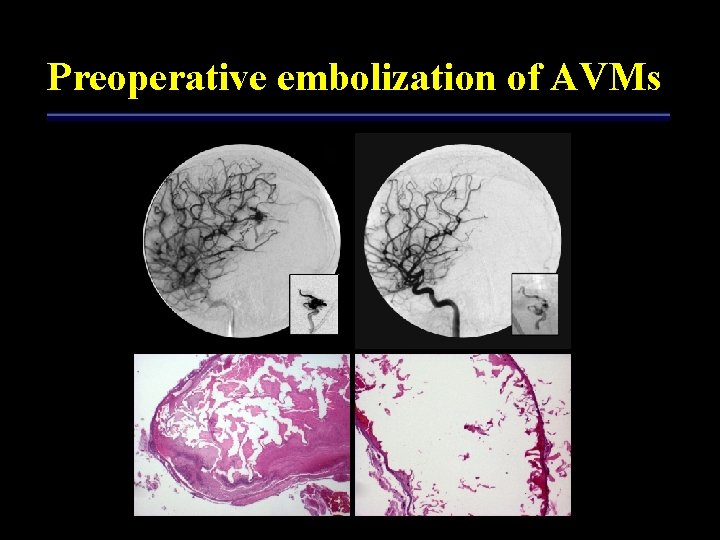 Preoperative embolization of AVMs 