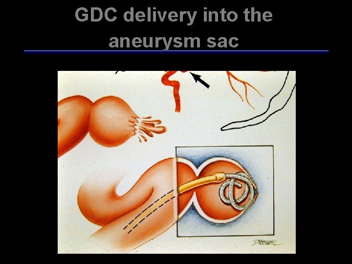 GDC delivery into the aneurysm sac 