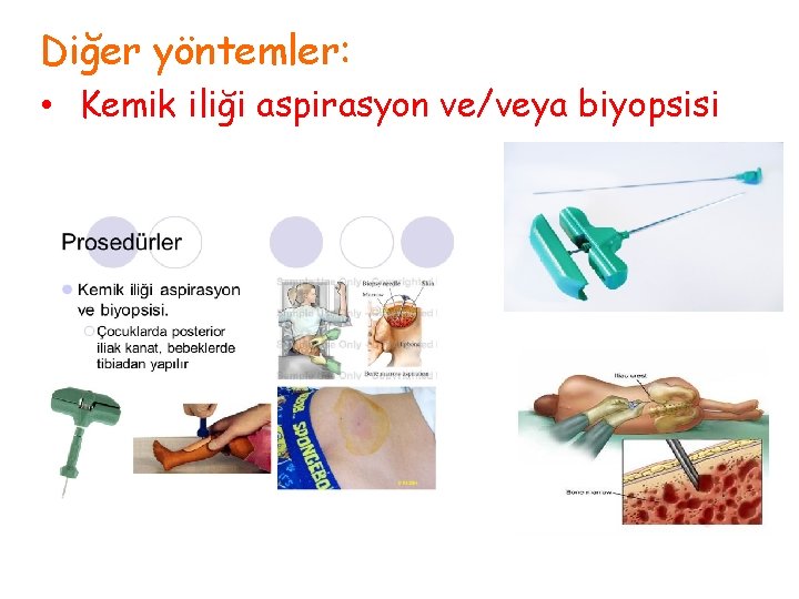 Diğer yöntemler: • Kemik iliği aspirasyon ve/veya biyopsisi 