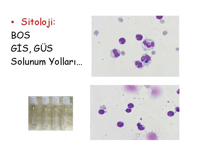  • Sitoloji: BOS GİS, GÜS Solunum Yolları… 