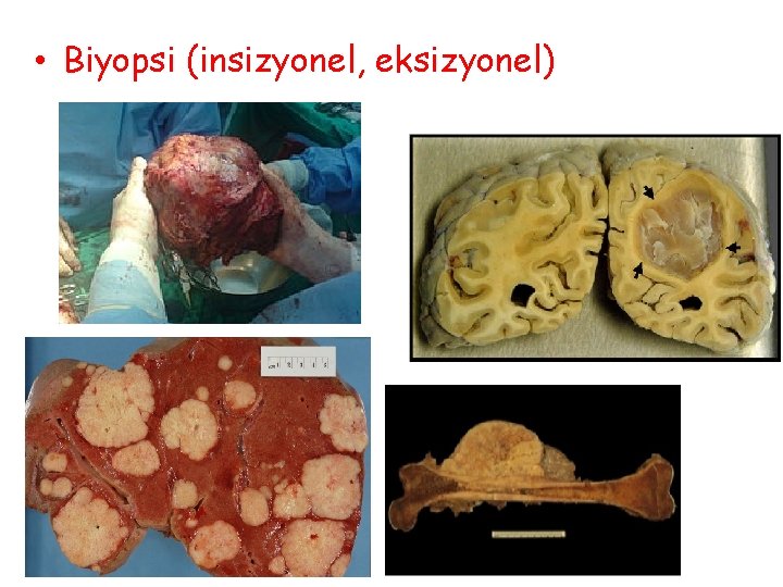  • Biyopsi (insizyonel, eksizyonel) 