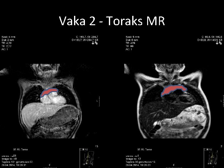 Vaka 2 - Toraks MR 