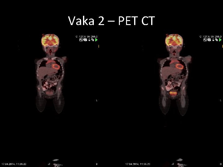 Vaka 2 – PET CT 