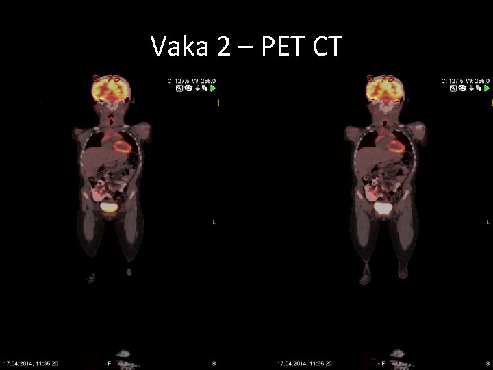 Vaka 2 – PET CT 