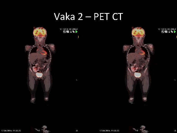 Vaka 2 – PET CT 