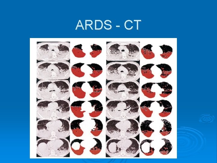 ARDS - CT 