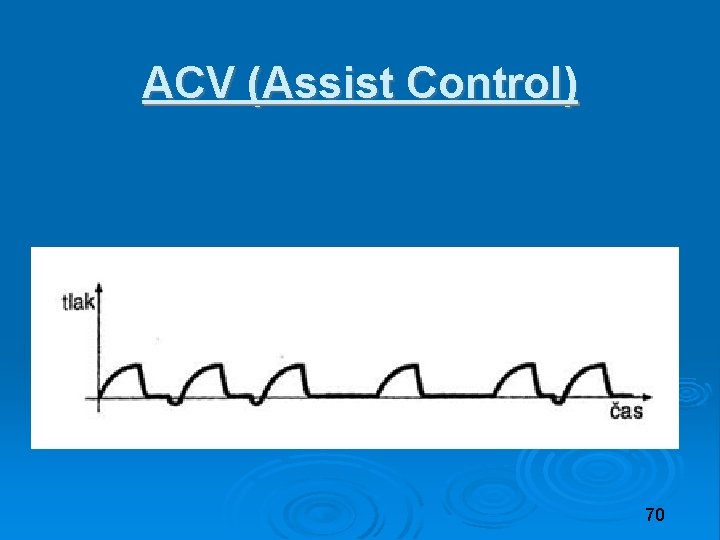 ACV (Assist Control) 70 