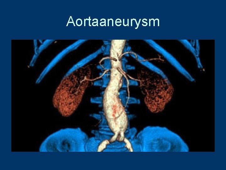 Aortaaneurysm 