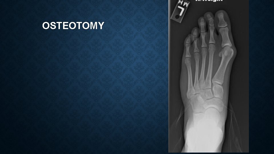 OSTEOTOMY 