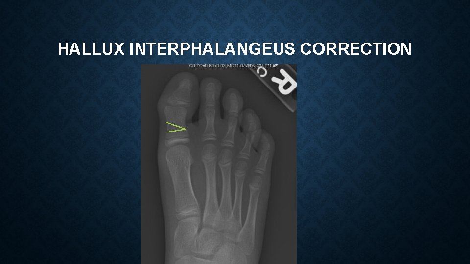 HALLUX INTERPHALANGEUS CORRECTION 