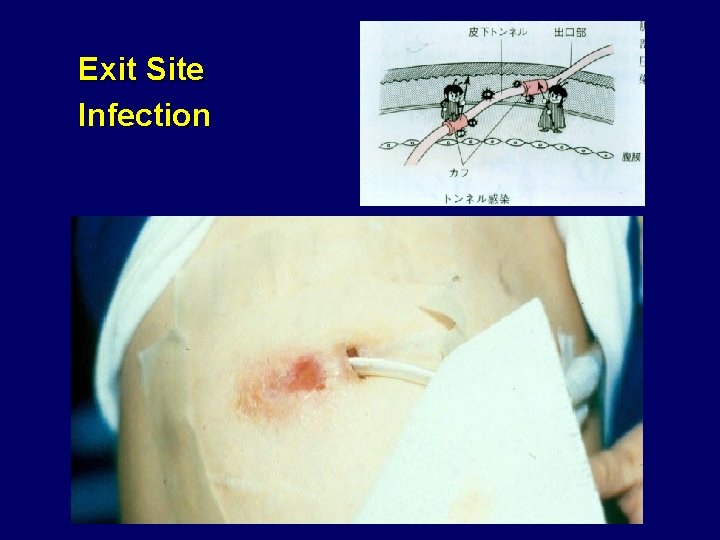 Exit Site Infection 