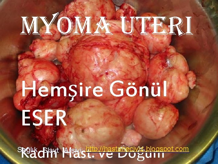 MYOMA UTERI Hemşire Gönül ESER Kadın Hast. ve Doğum Sağlık Slayt Arşivi: http: //hastaneciyiz.