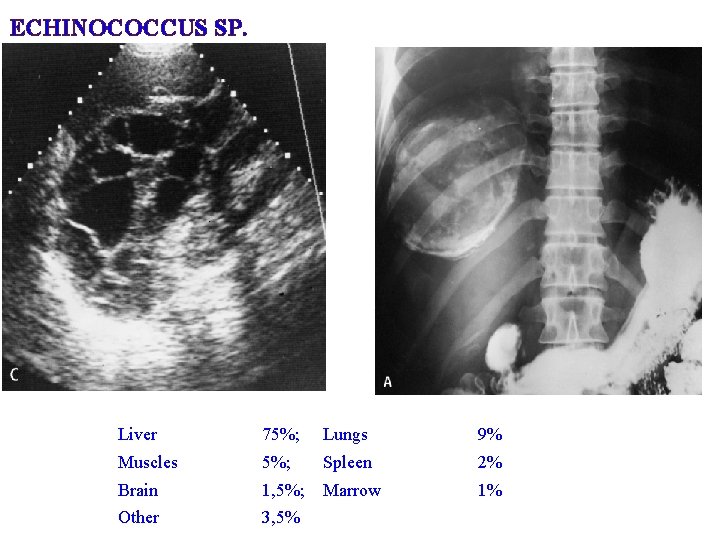 ECHINOCOCCUS SP. Liver 75%; Lungs 9% Muscles 5%; Spleen 2% Brain 1, 5%; Marrow ECHINOCOCCUS SP. Liver 75%; Lungs 9% Muscles 5%; Spleen 2% Brain 1, 5%; Marrow