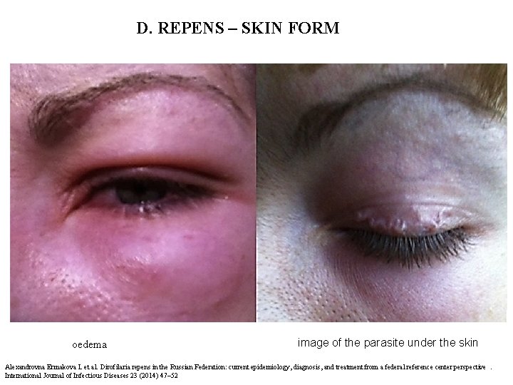 D. REPENS – SKIN FORM oedema image of the parasite under the skin Alexandrovna D. REPENS – SKIN FORM oedema image of the parasite under the skin Alexandrovna