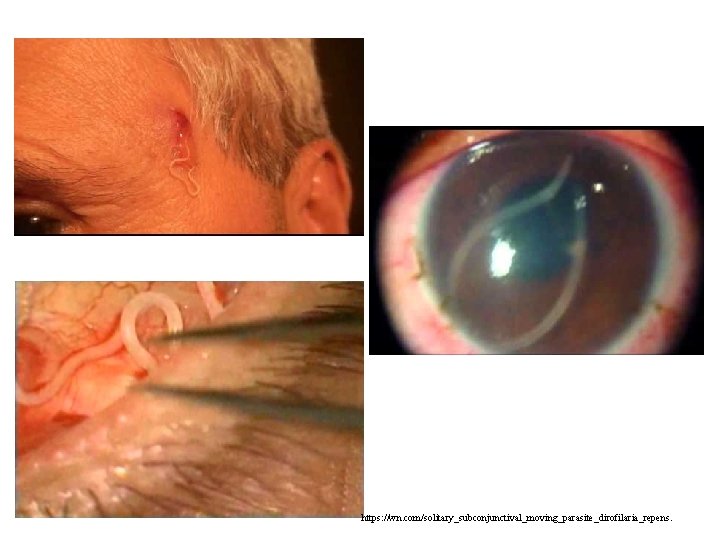 https: //wn. com/solitary_subconjunctival_moving_parasite_dirofilaria_repens. https: //wn. com/solitary_subconjunctival_moving_parasite_dirofilaria_repens.