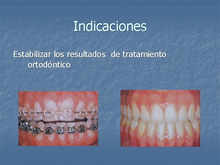 Indicaciones Estabilizar los resultados de tratamiento ortodóntico 