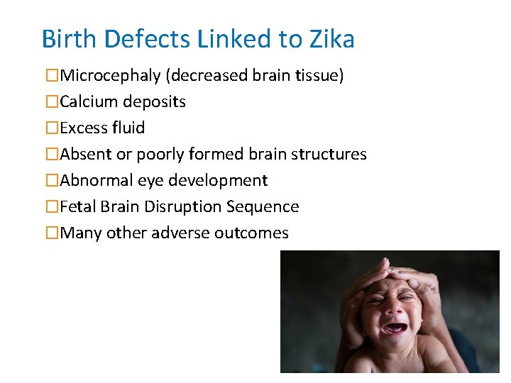 Birth Defects Linked to Zika �Microcephaly (decreased brain tissue) �Calcium deposits �Excess fluid �Absent