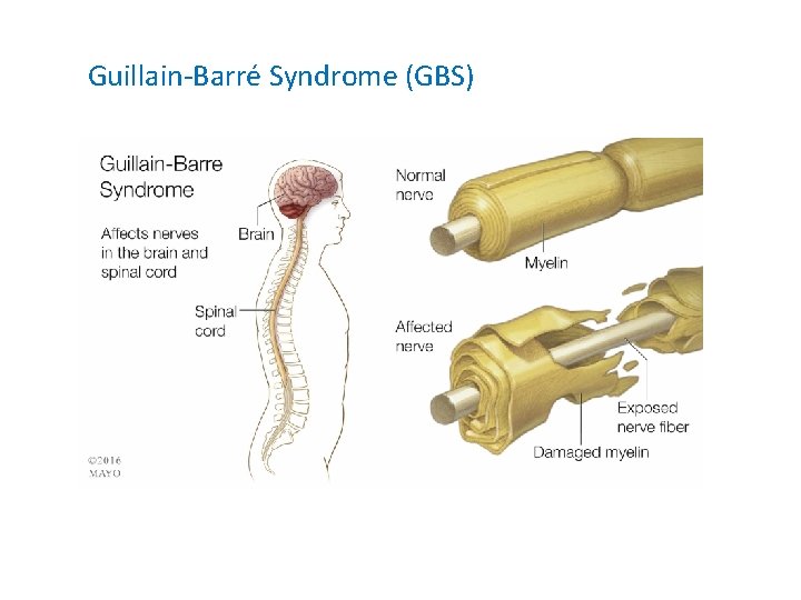 Guillain-Barré Syndrome (GBS) 