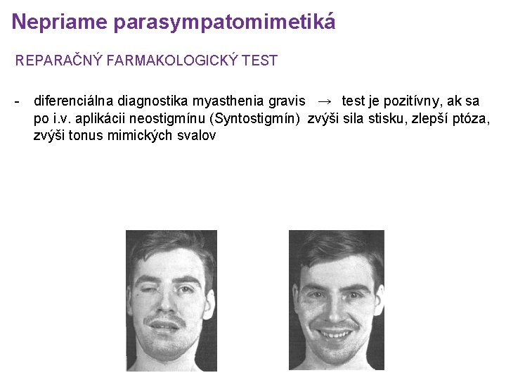 Nepriame parasympatomimetiká REPARAČNÝ FARMAKOLOGICKÝ TEST - diferenciálna diagnostika myasthenia gravis → test je pozitívny,