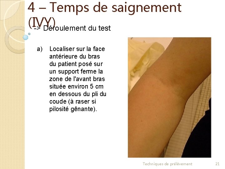 4 – Temps de saignement (IVY) -> Déroulement du test a) Localiser sur la