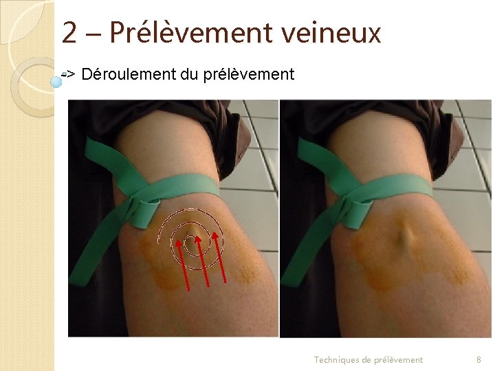 2 – Prélèvement veineux -> Déroulement du prélèvement b) Antisepsie Ø Passer sur la