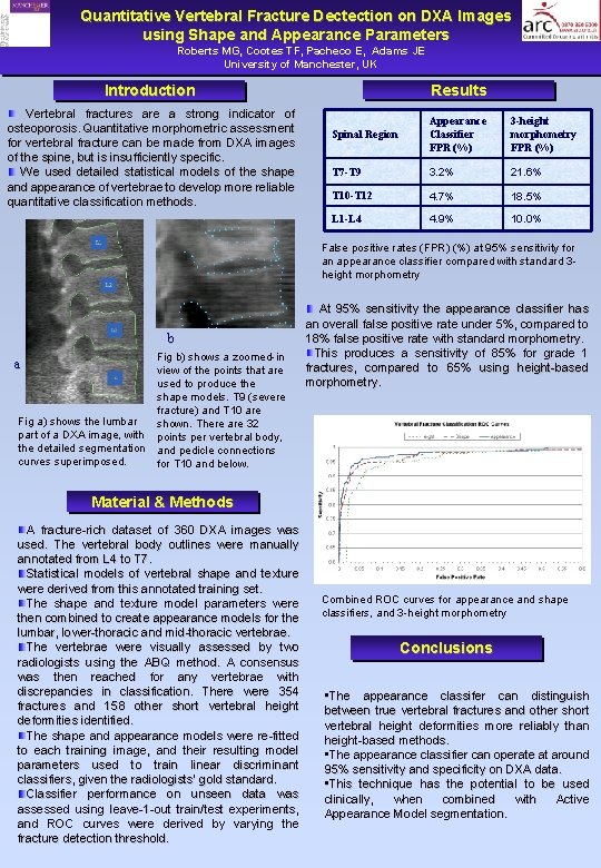 Quantitative Vertebral Fracture Dectection on DXA Images using Shape and Appearance Parameters Roberts MG,