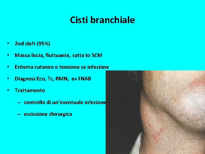 Cisti branchiale • 2 nd cleft (95%) • Massa liscia, fluttuante, sotto lo SCM