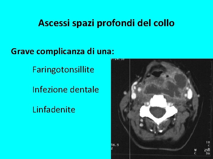 Ascessi spazi profondi del collo Grave complicanza di una: Faringotonsillite Infezione dentale Linfadenite 