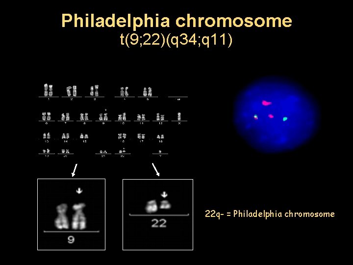 Philadelphia chromosome t(9; 22)(q 34; q 11) 22 q- = Philadelphia chromosome 