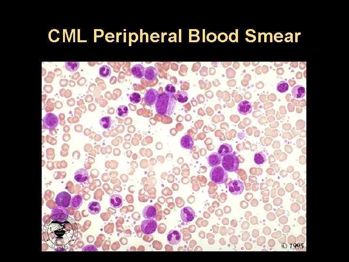 CML Peripheral Blood Smear 