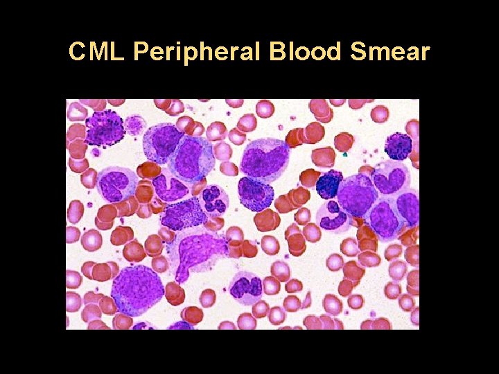 CML Peripheral Blood Smear 