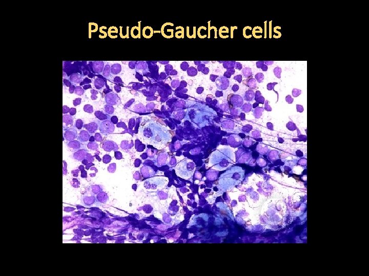 Pseudo-Gaucher cells 