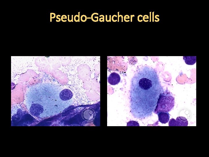 Pseudo-Gaucher cells 