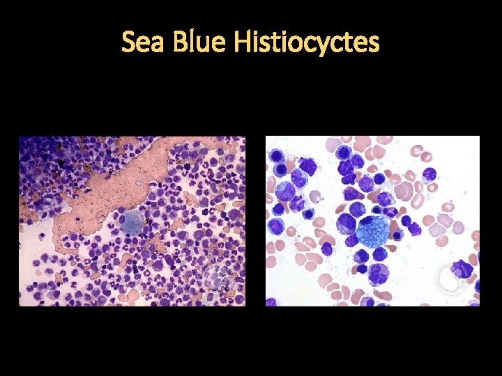 Sea Blue Histiocyctes 
