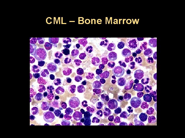 CML – Bone Marrow 