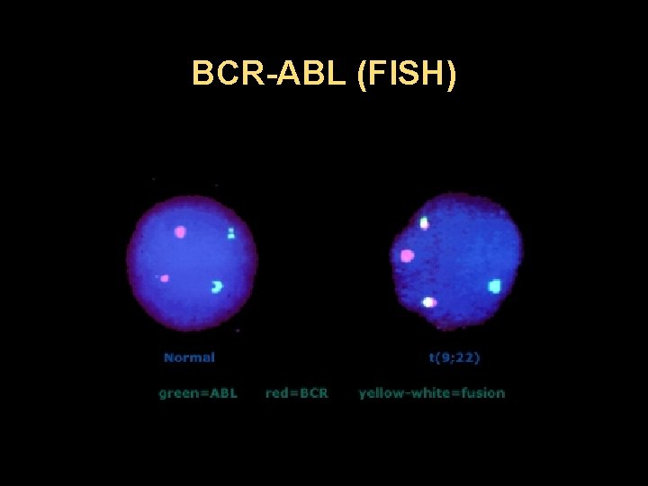 BCR-ABL (FISH) 