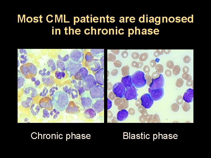 Most CML patients are diagnosed in the chronic phase Chronic phase Blastic phase 