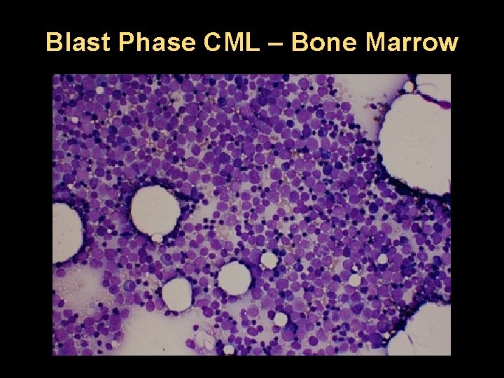 Blast Phase CML – Bone Marrow 