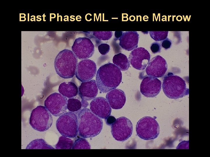 Blast Phase CML – Bone Marrow 