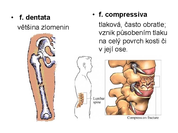  • f. dentata většina zlomenin • f. compressiva tlaková, často obratle; vznik působením